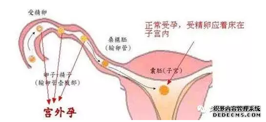 泰安沙雅县患上宫外孕该怎么办才好