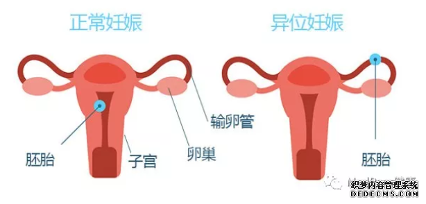 泰安库车县女性为什么会得宫外孕呢