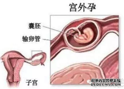泰安沙雅县女性患上宫外孕的几率有多大